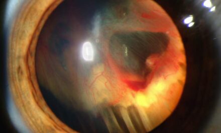 ¿Qué es un agujero macular?