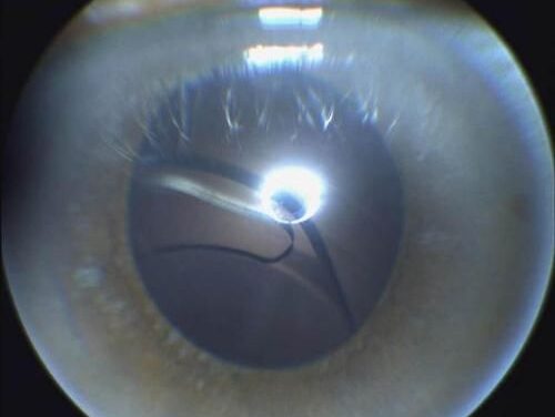 Desprendimiento de retina