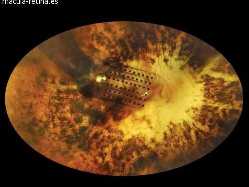 Prótesis de retina Argus® II