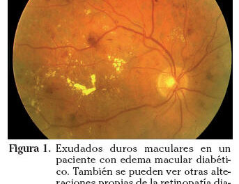 Edema macular diabético