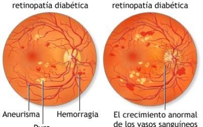 Tratamiento de la retinopatía diabética