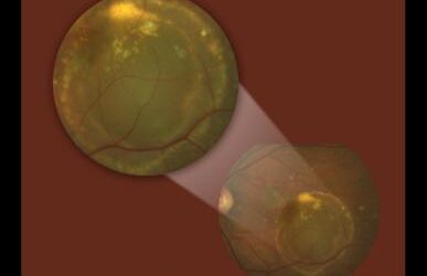 Lo que necesita saber el óptico-optometrista sobre enfermedades de la retina