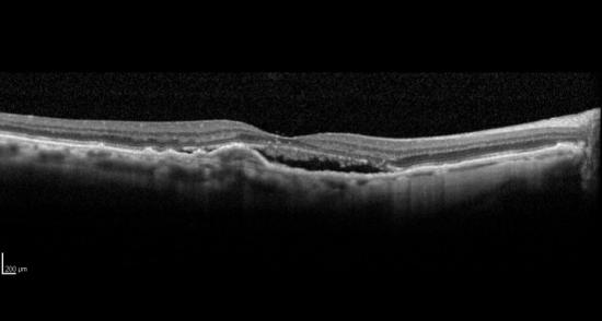 Ensayo clínico para pacientes DMAE húmeda sin respuesta óptima