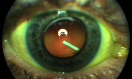 Allergan anuncia la aprobación de la FDA de Tratamiento Ozurdex para DME