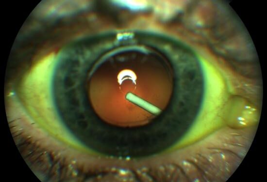 Allergan anuncia la aprobación de la FDA de Tratamiento Ozurdex para DME