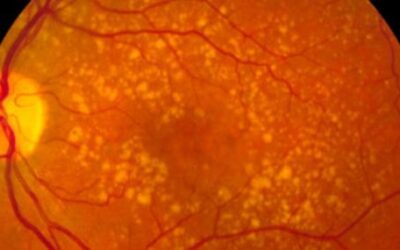 Ensayos conjuntos del IOBA y el Clínico de Valladolid para tratar enfermedades oculares