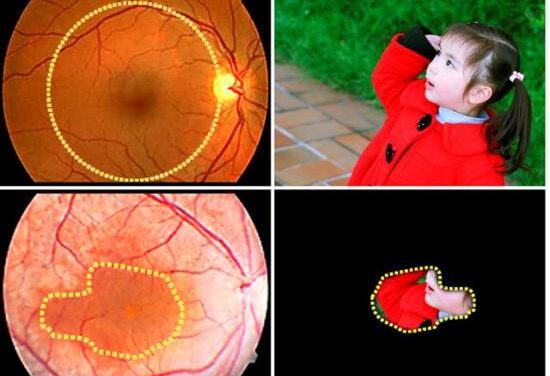 Células madre específicas del paciente y terapia genética personalizada