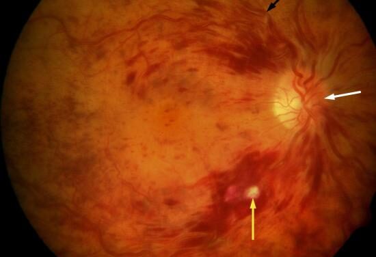 La etapa temprana de la DMAE puede empezar mucho antes de lo que se pensaba