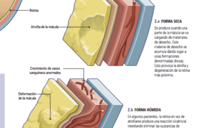 Un nuevo tratamiento frena la pérdida de visión de pacientes con DMAE seca