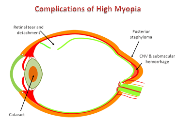 La miopía va en aumento en toda Europa