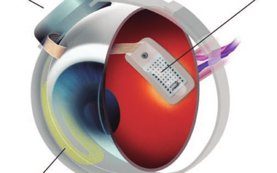Sistema de prótesis de retina Argus II