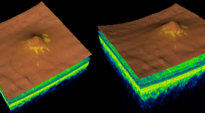 Diferencias entre maculopatía y la degeneración macular