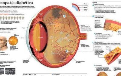 Descripción de la Retinopatía Diabética