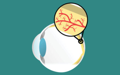 Envejecimiento de las células inmunes asociado con la DMAE