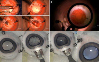 Implante de retina para que sea más eficaz contra la ceguera