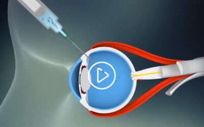 Datos adicionales positivos para GS010 en LHON