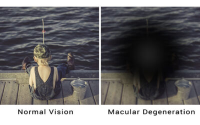 DMAE y calidad de vida