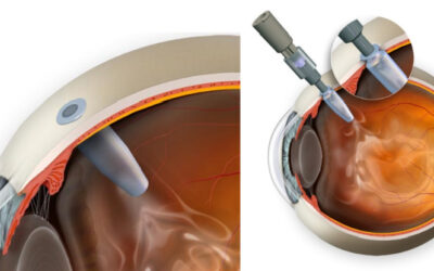 Tratamiento más llevadero para la DMAE húmeda