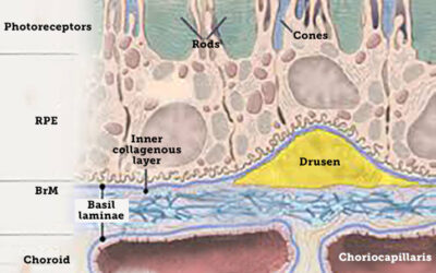 ¿Qué son las drusas maculares?
