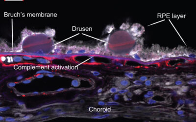 Degeneración macular relacionada con la edad: 5 cosas que debe saber