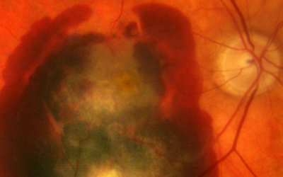 La importancia de las células madre para la cura de la DMAE