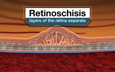 Retinosquisis