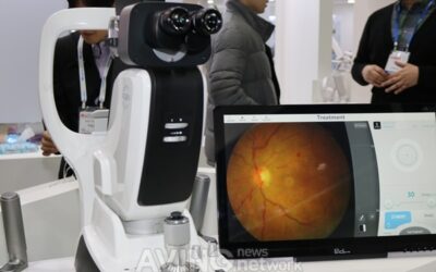 Ensayo con R:GEN Láser para tratamiento de la DMAE seca