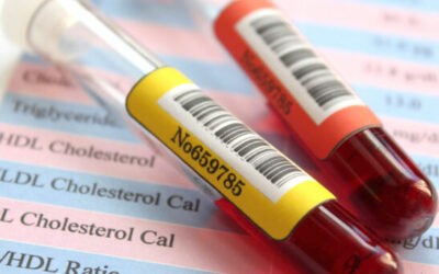 Estudio muestra correlación entre HDL, triglicéridos y DMAE