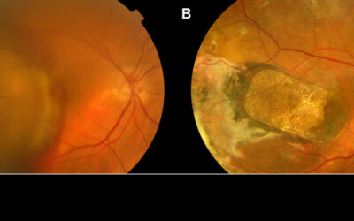 Trasplantes celulares y DMAE