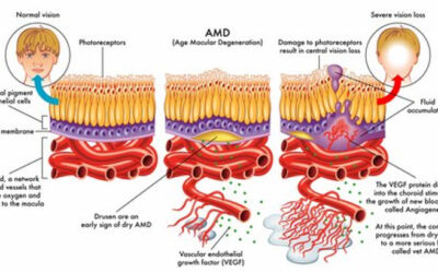 Neovascularización Coroidea