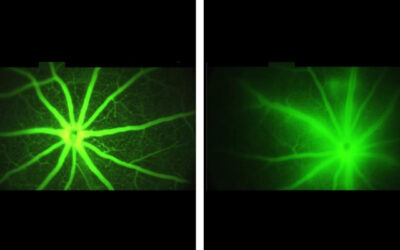 AXT107 evita que los vasos sanguíneos anormales en el ojo pierdan líquidos que bloquean la visión
