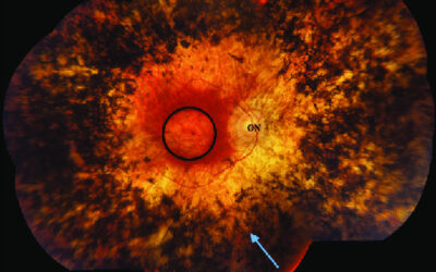 ¿Qué es la retinosis pigmentaria?