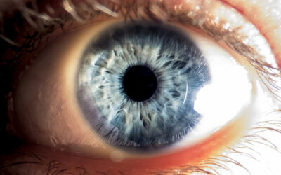 Distrofia macular viteliforme de Best