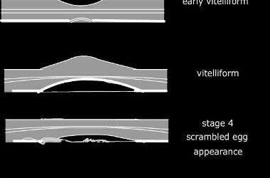 Distrofia macular viteliforme del adulto