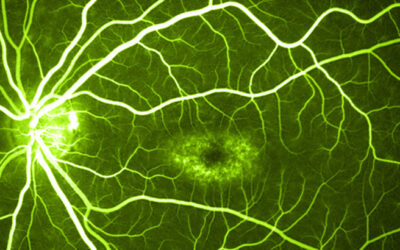 Enfermedad de Stargardt