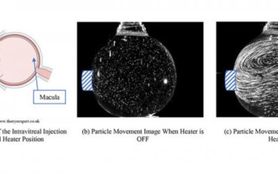 Los resultados del tratamiento de la DMAE mejoran con una mezcla eficiente de fluidos en el ojo