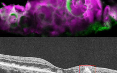 Descubren una proteína del esmalte dental en ojos con DMAE seca