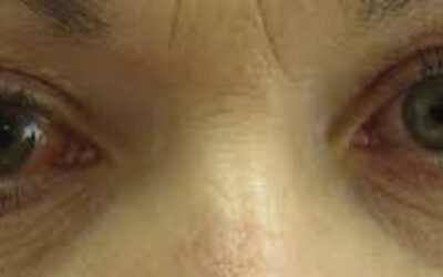 Aviso para afectados por patologías oculares crónicas