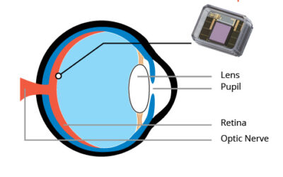 Nano Retina anuncia resultados preliminares para el primer implante en humanos de su dispositivo de retina artificial NR600