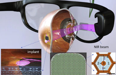 Restauración fotovoltaica de visión central en degeneración macular atrófica asociada a la edad