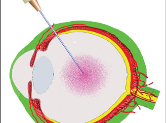 Inyecciones intravitreas para DMAE