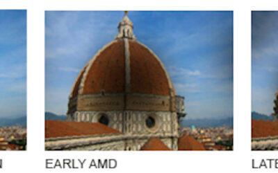 Qué es la DMAE seca