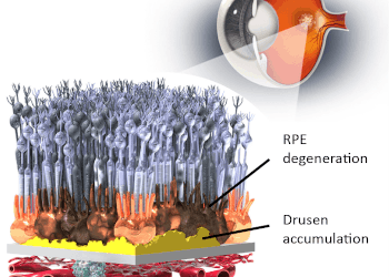 Lineage Cell Therapeutics informa de los resultados del estudio OpRegen