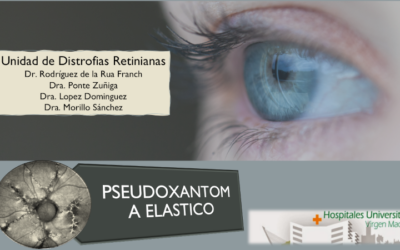 Pseudoxantoma elástico (PXE) o Síndrome de Gronblad-Stranberg