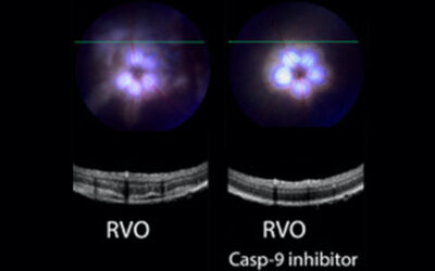 Un colirio puede prevenir la oclusión de la vena central de la retina
