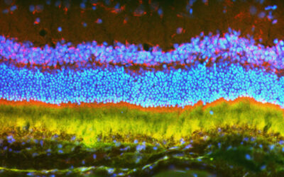 Uso de nanopartículas para administrar terapia genética para la DMAE húmeda