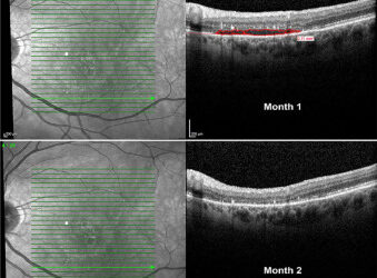 Un medicamento para Parkinson puede mejorar la visión en pacientes con DMAE