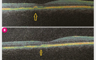 Fotobiomodulación: aprovechando el poder de la luz en la degeneración macular seca relacionada con la edad DMAE