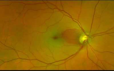 Obstrucción de la arteria central de la retina