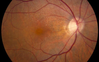 Estudio internacional sobre la progresión de la DMAE